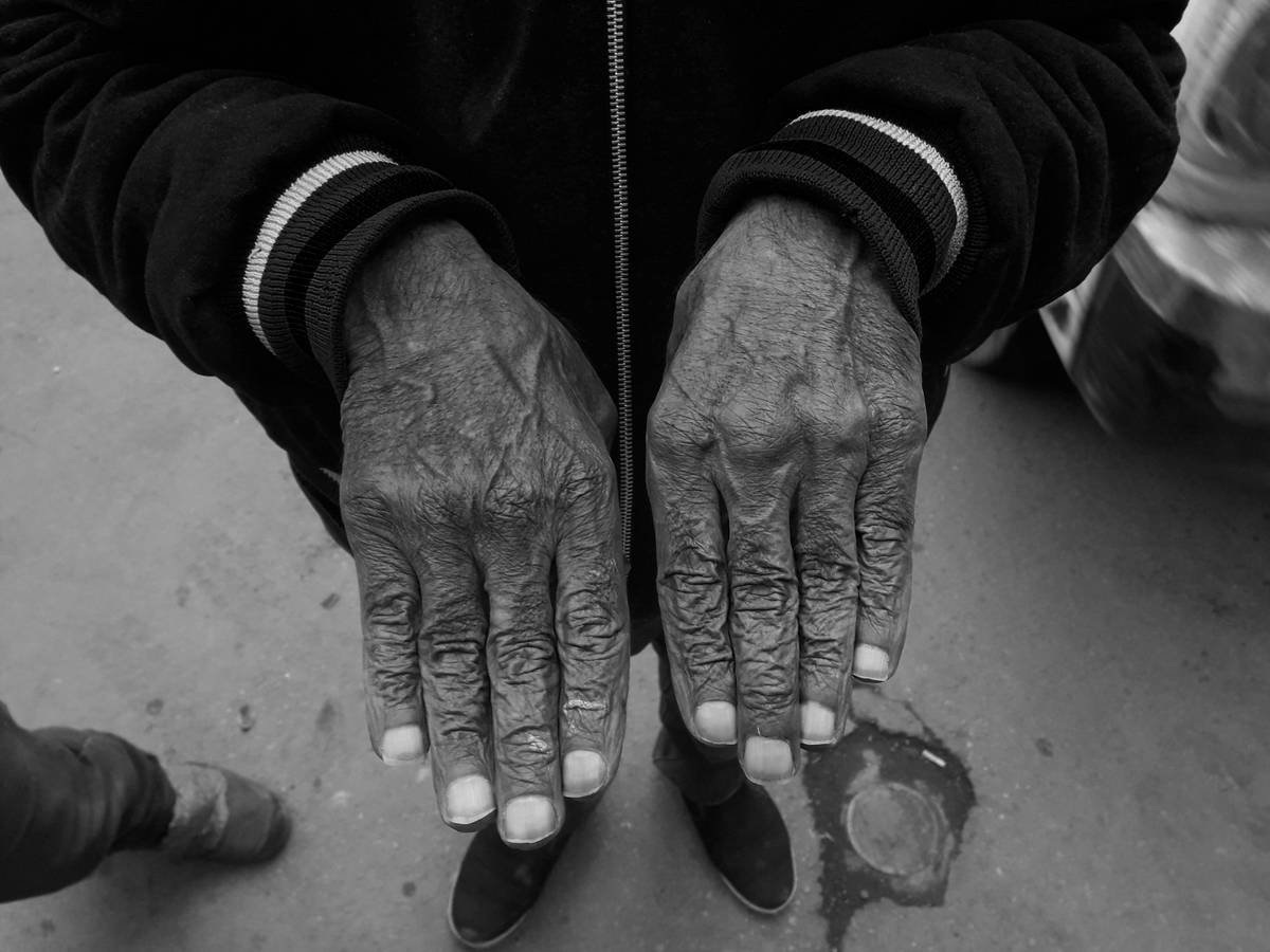 Diagram showing layers of a human nail impacted by aging