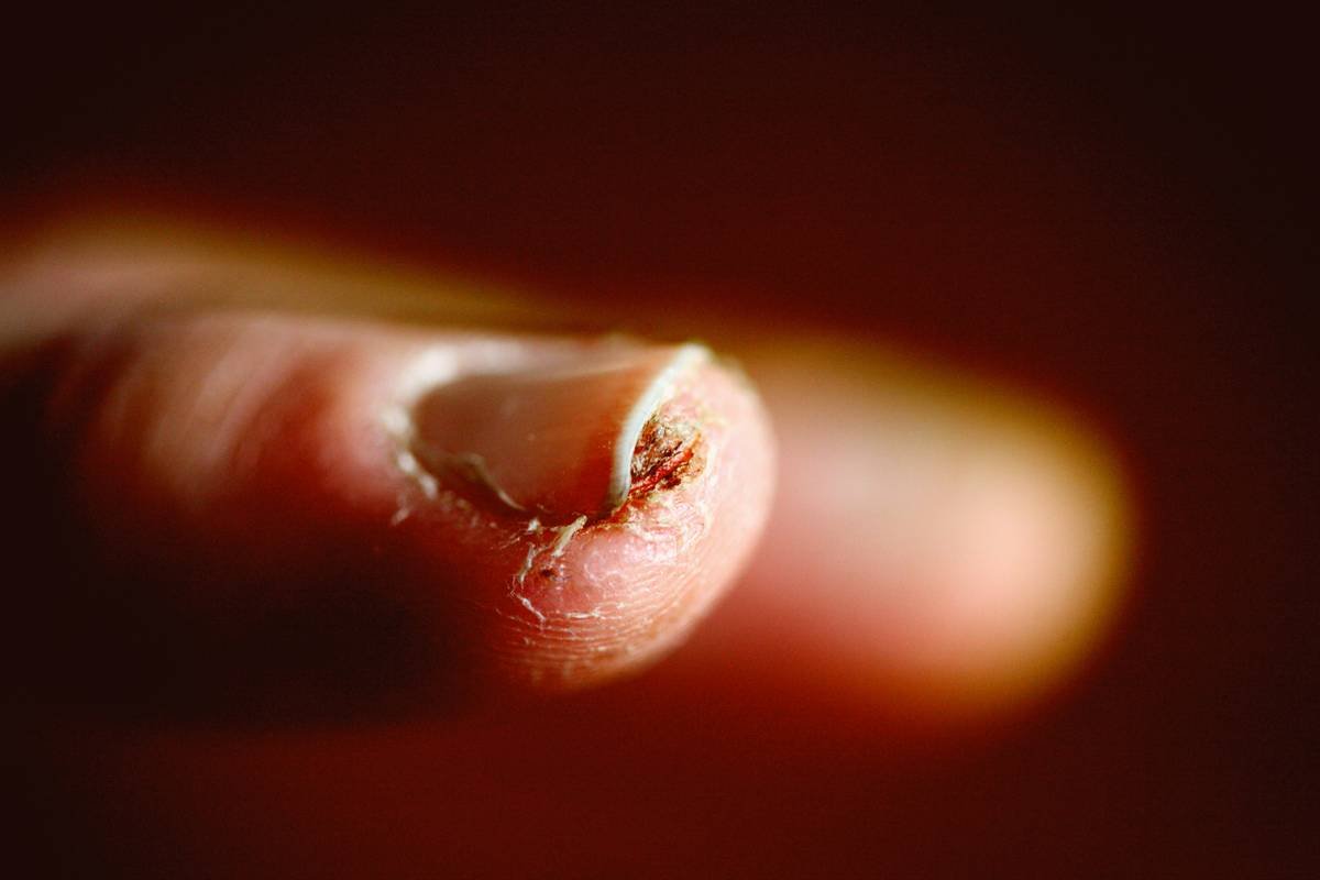 Close up of a fissure from having very dry skin.